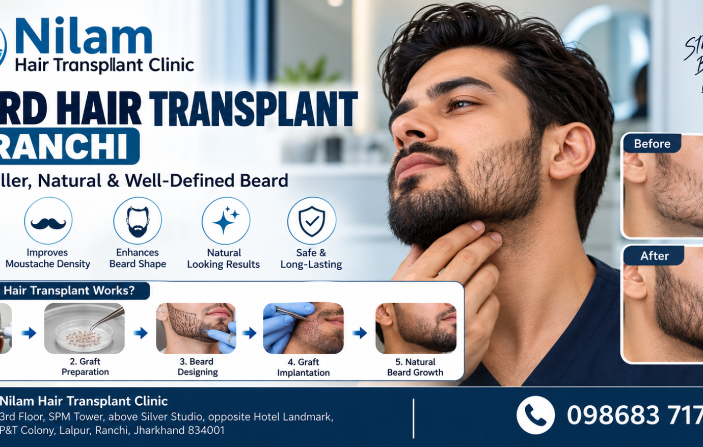 Beard Hair Transplant in Ranchi